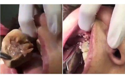女子洗牙..醫生竟夾出「巨大噁黃結石」網友驚：到底多久沒刷牙