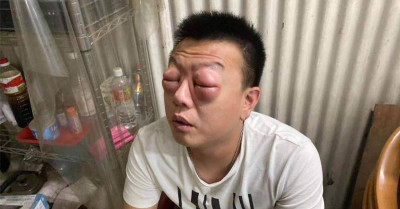 吃完中藥「雙眼睜不開」！台南男崩潰衝醫院...一看鏡子驚呆了