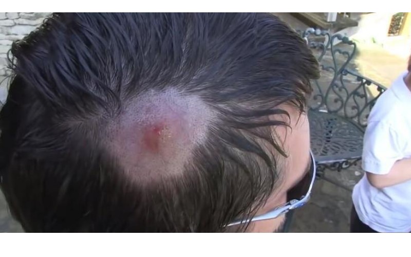 男子從國外回來發現頭上腫了一塊以為是「痘痘」…沒想到用力一擠竟噴出爆噁蟲蟲！（影）